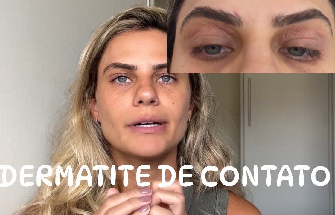DERMATITE DE CONTATO