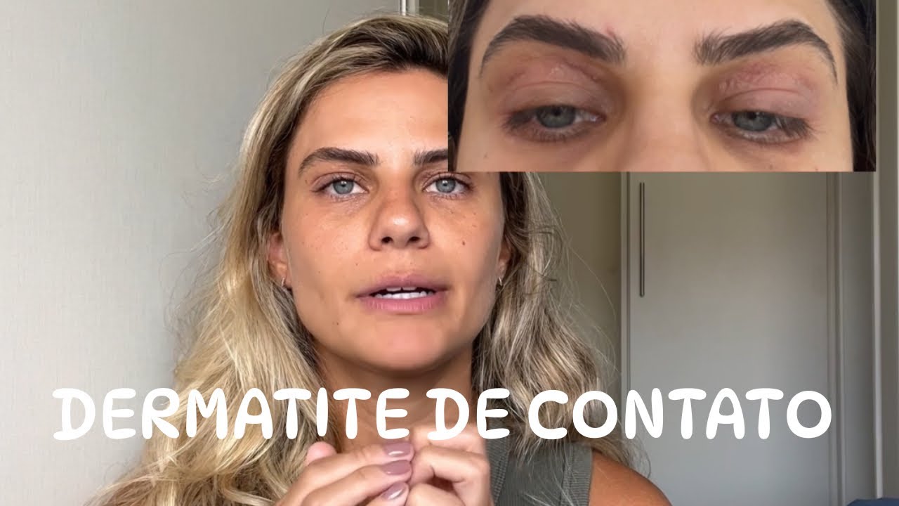 DERMATITE DE CONTATO